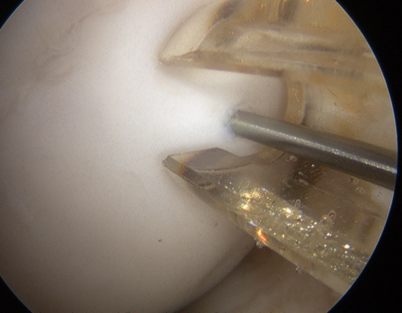 Femoral OCD K wire